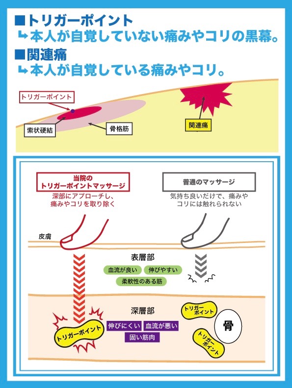 トリガーポイント施術のイラスト
